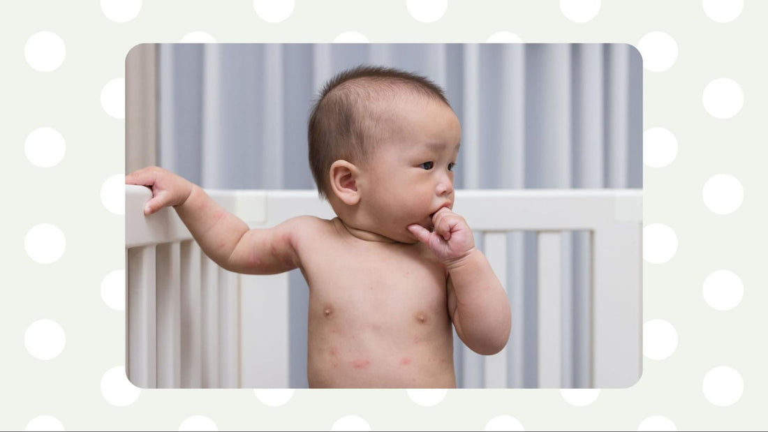Impetigo in Babies: How to Identify, Treat & Prevent Spreading
